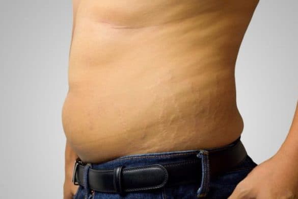 Best Home Remedies For Stretch Marks Removal Treatment And Causes
