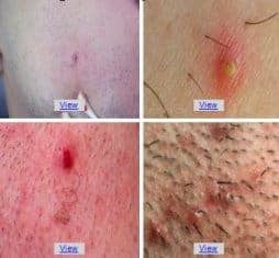 ingrown hairs pubic causes beautyclue boil