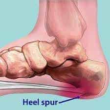 Posterior Calcaneal Spur