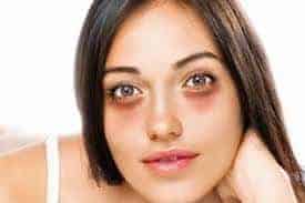 Bags under eyes Causes