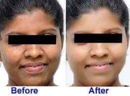 Skin Lightening Cream Before After