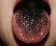 Pepto Bismol Black Tongue 115