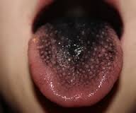 Black tongue