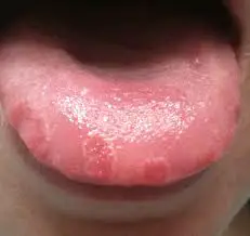 Brown Spots In Mouth 19