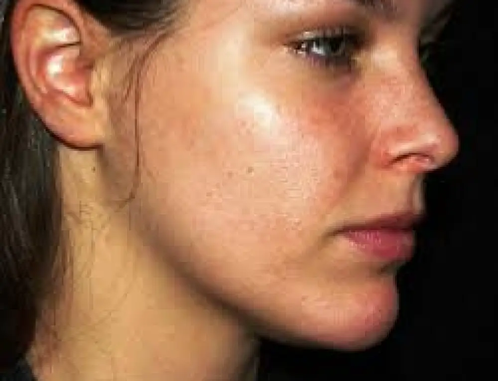 Sun Poisoning on Face How to Treat Swollen, Blisters from Sun
