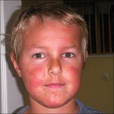 How to heal sun poisoning