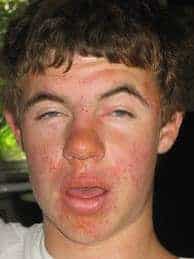 How to treat sun poisoning itching and swelling