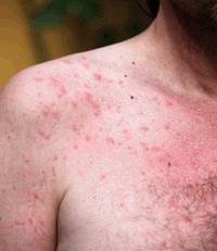 Sun Poisoning Rash – Treatment What to Do & How to Sun Poisoning Rash – Treatment What to Do & How to