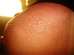 Sun Poisoning rush