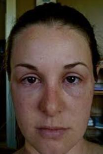 Steroid cream reduce swelling