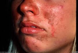 What causes sun poisoning