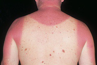 itchy burning skin after sunburn
