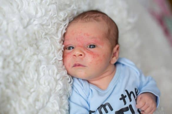 Baby Acne Meaning What Causes Symptoms Pictures Types And How To 