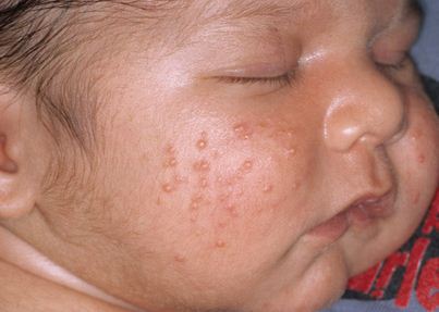 Baby-acne - Aandoeningen - Dokterdokter.nl