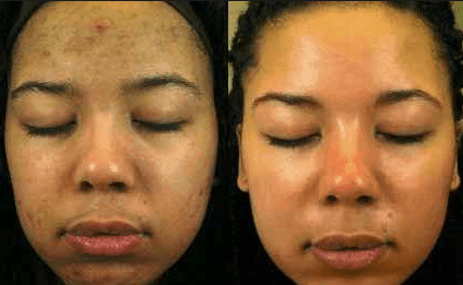 before and after hydrogen peroxide skin lightening