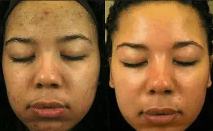 before and after hydrogen peroxide skin lightening