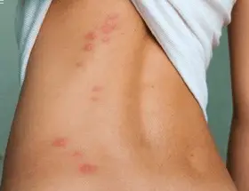 let the bed bugs bite but it s not because the bed bug bites hurt an ...