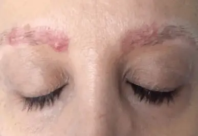 how to get rid of between eyebrow acne