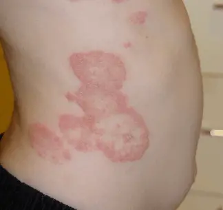 Tinea Versicolor