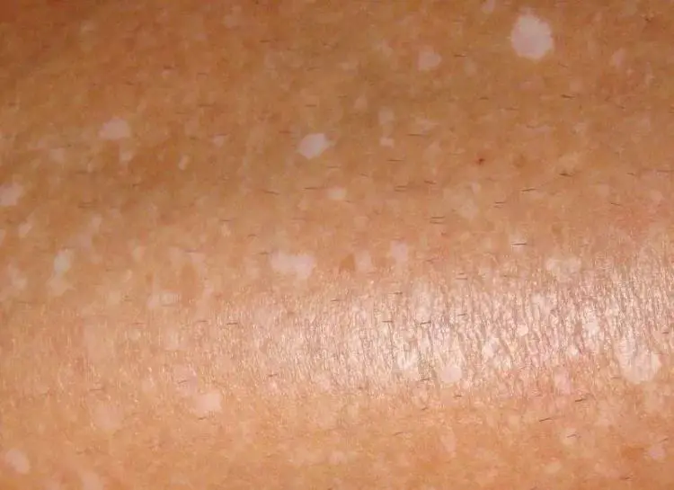 White Spots On Legs Dry Spots Itchy Blood Circulation Thighs