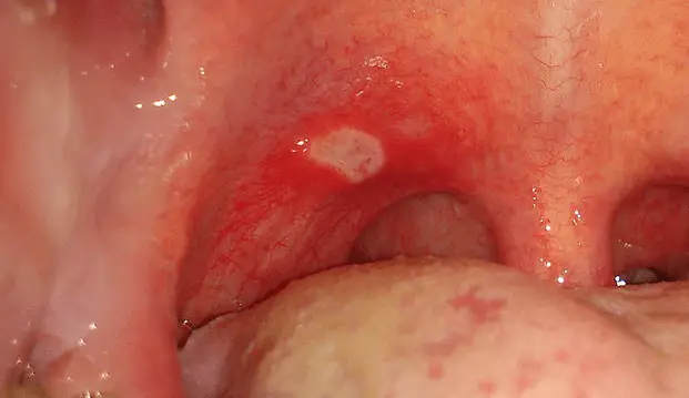 White Spot On Back Of Throat 13