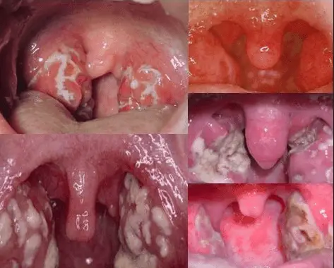 White Spots In The Back Of Throat 23