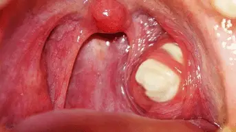 white spot cancer