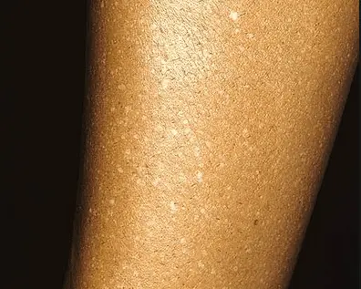 white spots after tanning
