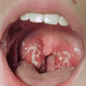 white spots on back of tonsils