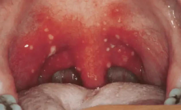 Swollen Throat With White Spots 57