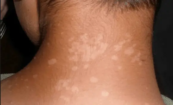white spots on the neck