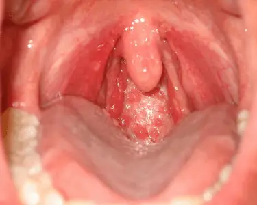 White Spots Back Of Throat 25