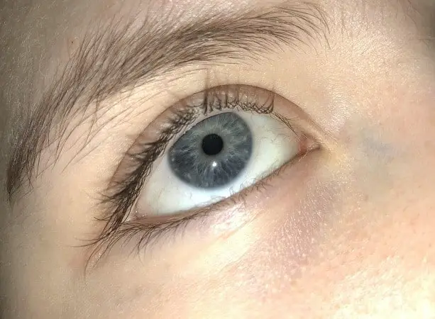 White Spots under Eyes, Little, Not Milia, Pictures, Cholesterol, Eyelid, Chicken, Red, Small ...