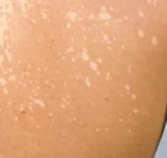 White Spots on Body, Causes, Small, Sun, Fungus, Tanning, Legs, Cancer