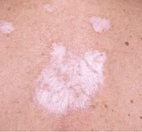 Facial White Spots 118