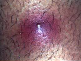 Infected Ingrown Hair Treatment Prevention Causes And Symptoms