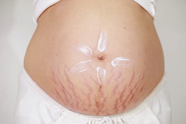 How To Reduce Pregnancy Stretch Marks Naturally