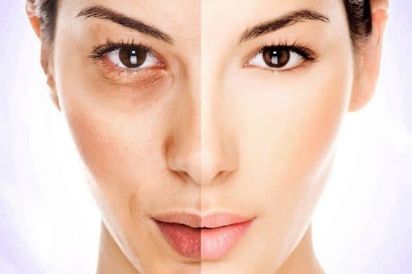 How to Get Rid of Bags Under Eyes - Overnight, Fast, Naturally, At Home