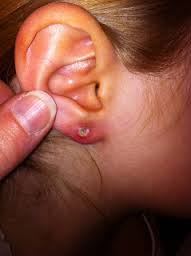 Infected Ear Piercing Symptoms Signs Swollen How To Heal An Infected Ear Piercing Signs