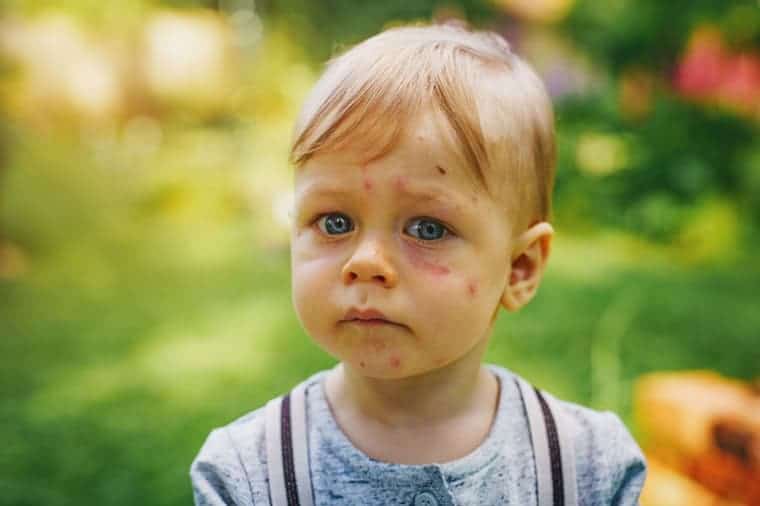 Baby Acne Meaning, What Causes, Symptoms, Pictures, Types and How to