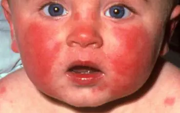how baby acne look like