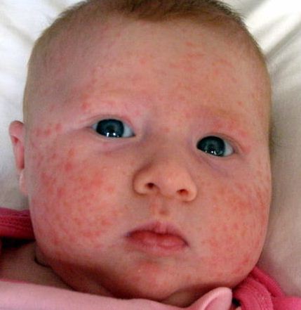 what causes acne in babies