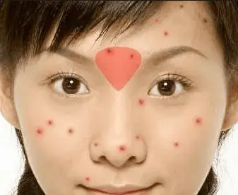 Acne between eyebrows - liver