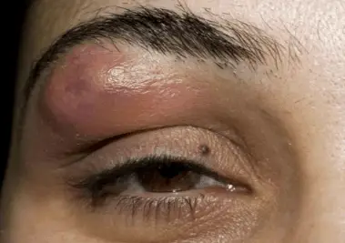 Pimple below eyebrow swollen
