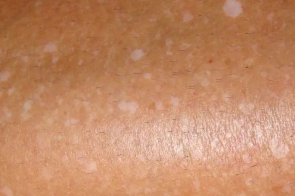 White Spots On Throat Causes Cancer Blisters No Pain No Fever Red 