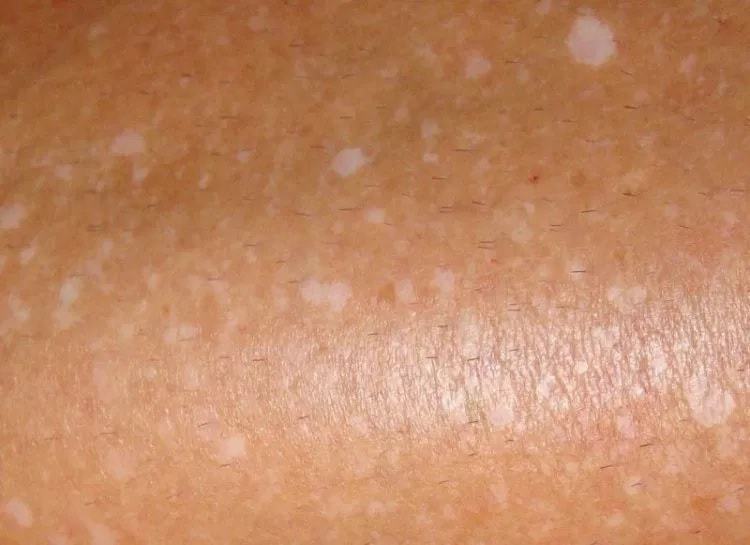 White Spots On Skin White Spots On Face Dots Patches Small