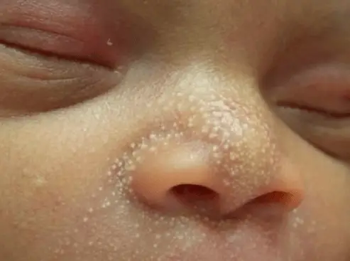White Spots on Face, Causes, Under Eye, Fungus, Symptoms, Pictures, Not