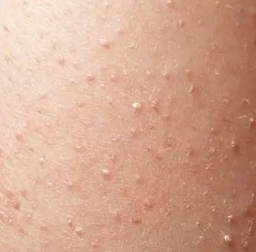 White Spots on Skin, Causes, Sun, Legs, Pictures, Fungus 