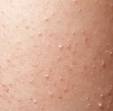White Spots on Skin, Causes, Sun, Legs, Pictures, Fungus