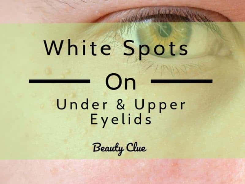 White Spots under Eyes, Little, Not Milia, Pictures